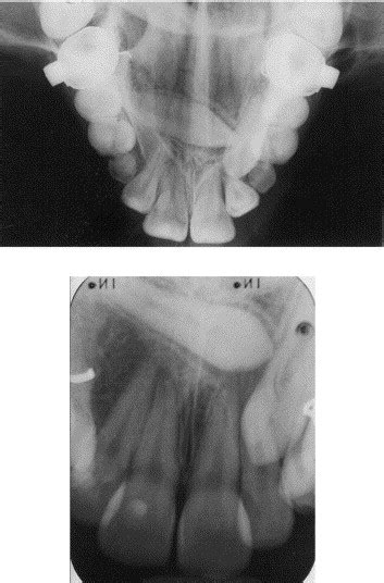 Unusual Intraosseous Transmigration Of A Palatally Impacted Canine