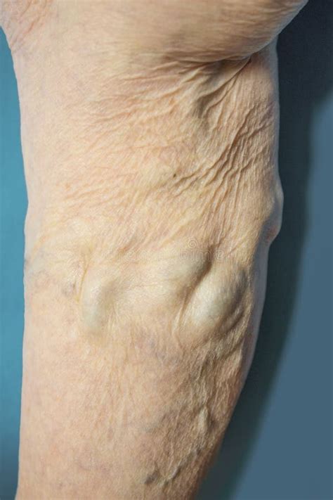 The Varicose Veins On A Legs Of Old Woman On Blue Stock Image Image