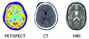 What is the main difference between ct scan and mri and which one is best. Biomarkers for Dementia Detection and Research