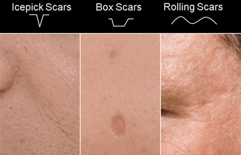 According to the american society for dermatologic surgery, acne scars are usually the result of inflamed blemishes caused by skin pores engorged. Micro Needling Side Effects - What to Expect After ...