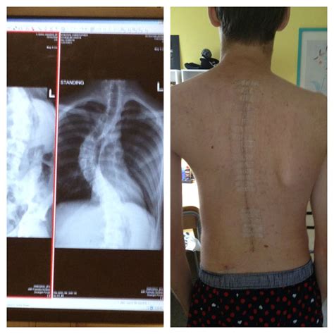 My Scoliosis Surgery Beforeafter Pic Wtf
