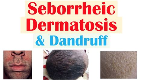 Seborrheic Dermatitis Dandruff And Cradle Cap Causes Risk Factors