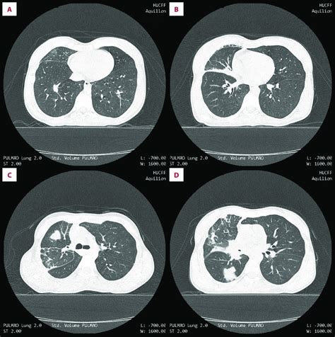 Ct Scan Of The Chest With A Lung Window Showing A Spiculated 15×11 Mm