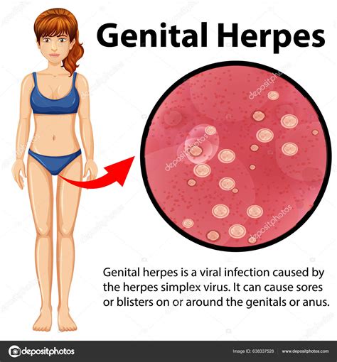 Genital Herpes Infographic Explanation Illustration Stock Vector By