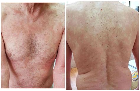 It is a chronic papulosquamous disorder of unknown etiology characterized by reddish orange scaly. Paraneoplastic pityriasis rubra pilaris in association ...