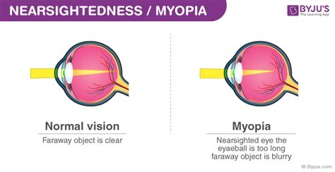 Myopia Causes Symptoms Formula And Nearsightedness