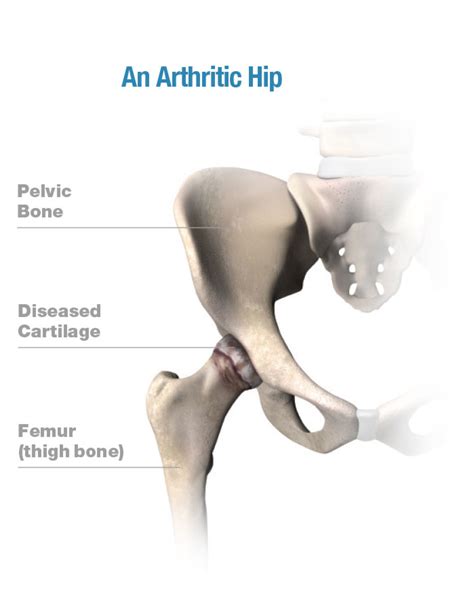 Hip Procedures Stryker Orthopaedics Uk