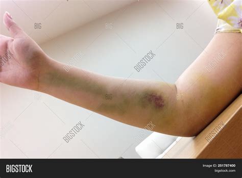 Bruises On Woman Arm Image And Photo Free Trial Bigstock