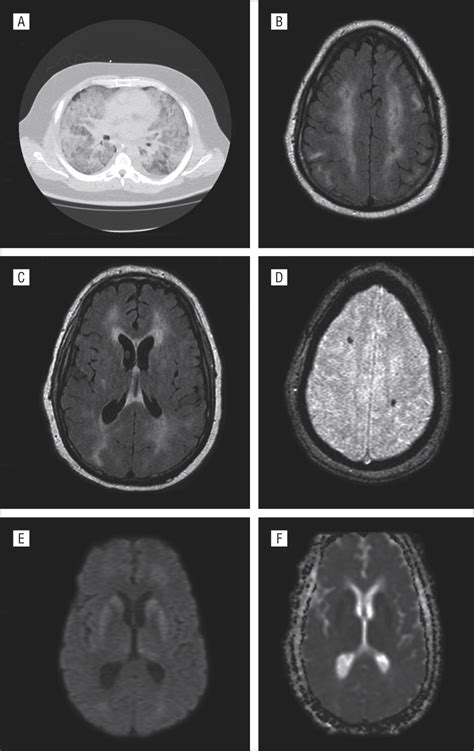 Acute Hemorrhagic Leukoencephalitis And Hypoxic Brain Injury Associated
