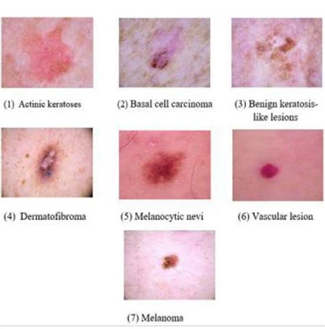 Medizzy Types Of Skin Lesion Cheat Sheet Nursing Scho