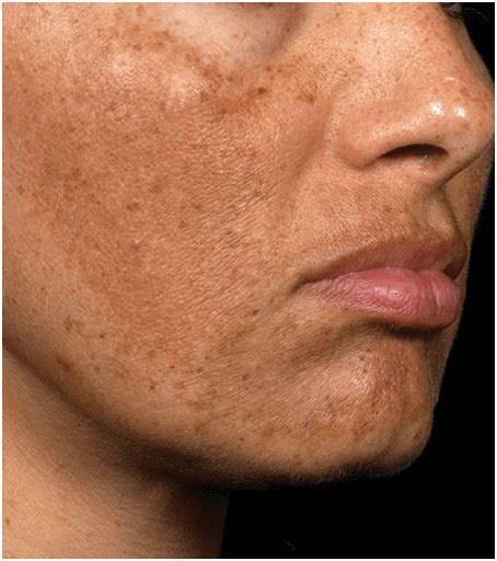 Fraxel Skin Resurfacing Dermphysicians Of New England