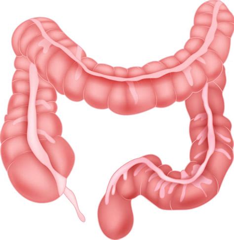 What Are Bowel Obstruction Symptoms With Pictures