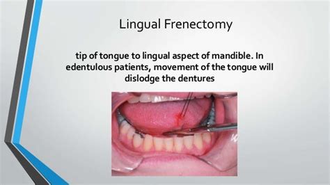 Lingual Frenectomy Procedure Pdf