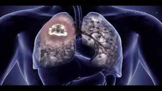 55 per cent of patients live for a period of six months after the diagnosis, and about 33 per cent live up to a year. Lung cancer asbestos mesothelioma.... - YouTube