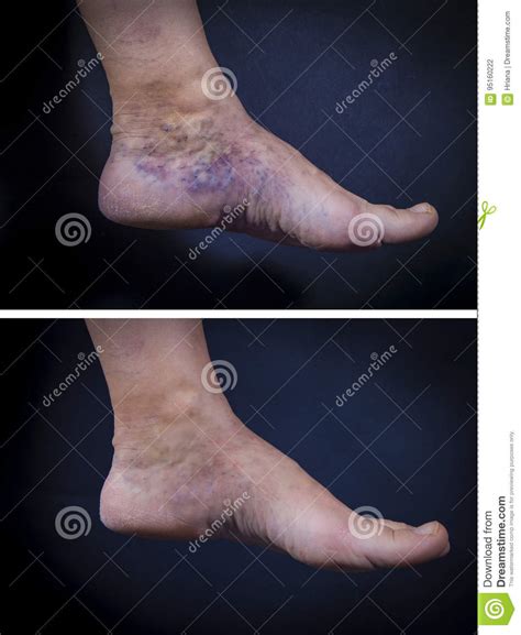 Human Foot With Varicose Veins Before And After Stock Photo Image Of