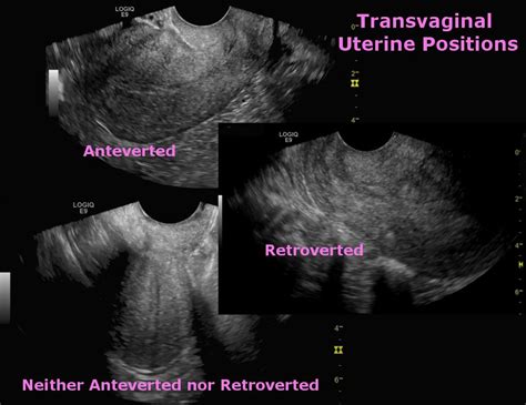 janet hoyler on twitter uterine positions on transvaginal ultrasound my xxx hot girl