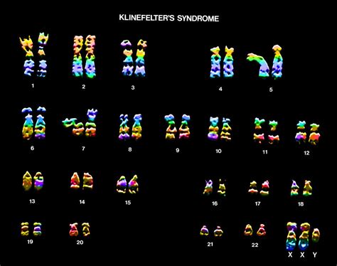Klinefelters Syndrome Karyotype Bild Kaufen 12030804 Science Photo