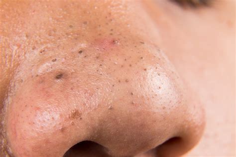 Ugly Pimples Acne Zit Blackheads On The Nose Of Teenager
