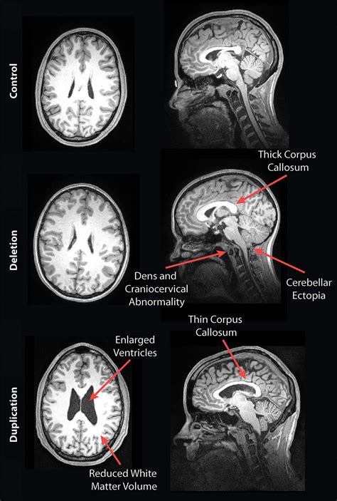 Mri Reveals Striking Brain Differences In People With Genetic Autism