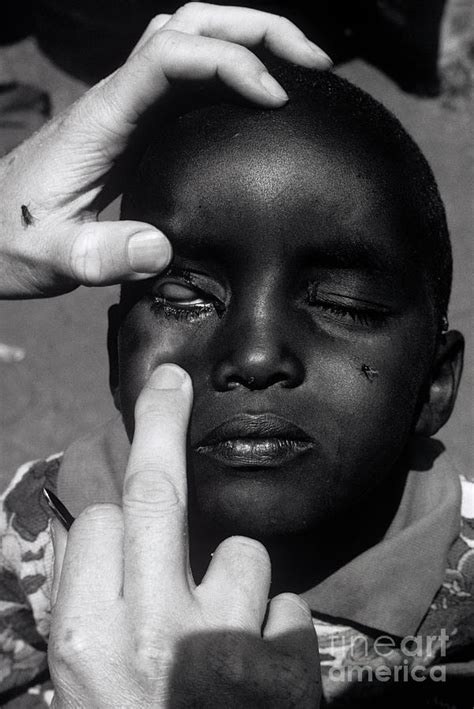Trachoma Eye Infection Treatment Photograph By Jason Kelvinscience