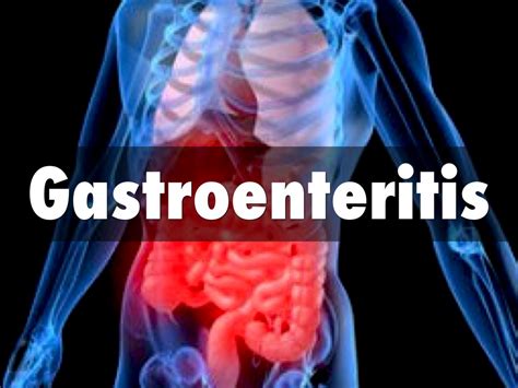 Gastroenteritis By Amy Ponder