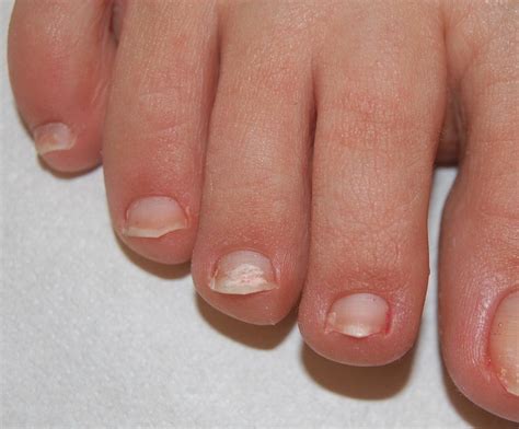 White Superficial Onychomycosis Wso White Opaque Friable Patches Of