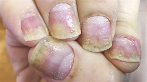 Nail Psoriasis Causes Symptoms Diagnosis Treatment And Prognosis
