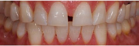 Corregimos Sonrisa Gingival Con Ortodoncia Invisible Y Estética Dental Clínica Peydro