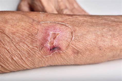 Cancer Related Wounds Venaziel