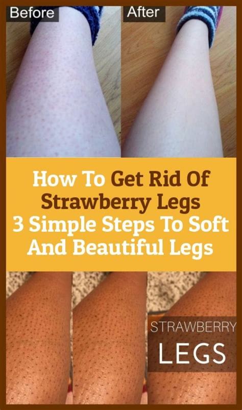 How To Rid Out Of Strawberry Legs 3 Simple Steps To Soft And