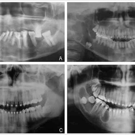 Radiographic Features Of Keratocystic Odontogenic Tumours In Panoramic