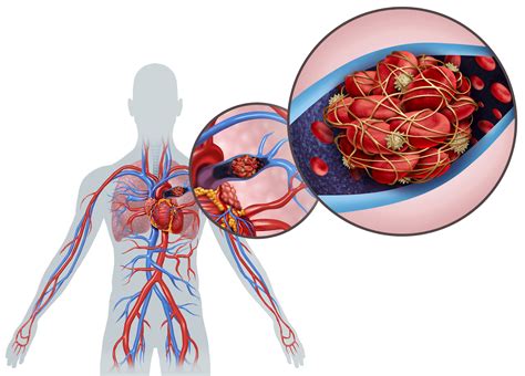 What Is A Pulmonary Embolism Yourcareeverywhere