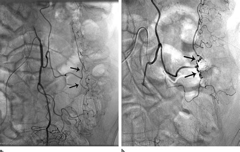 Empiric Embolization Of A Diverticular Bleed With Ct Angiographic