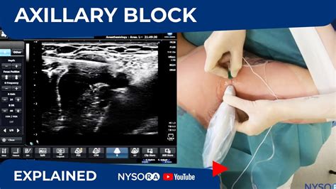 Ultrasound Guided Axillary Brachial Plexus Block Nysora Regional