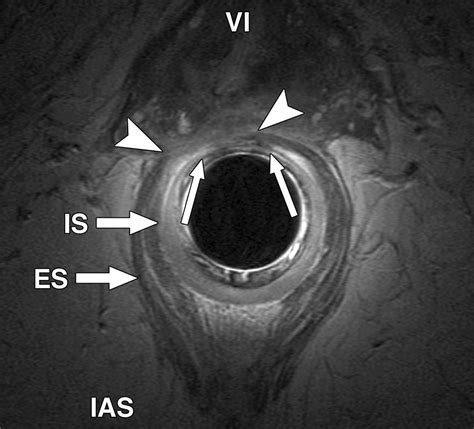 Cross Sectional Imaging Of The Anal Sphincter In Fecal Incontinence Ajr