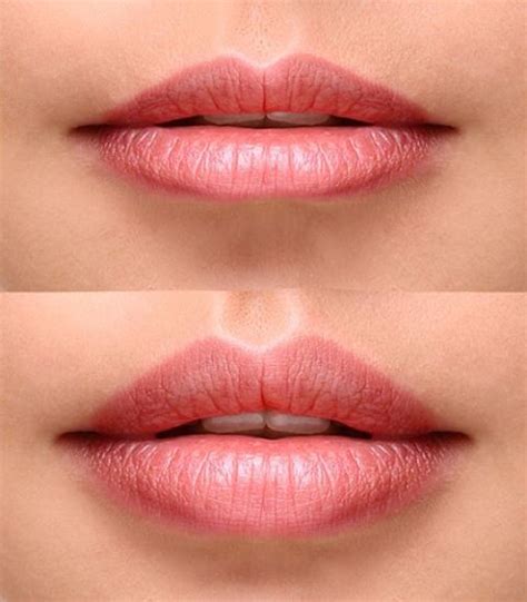 Lip fillers are made with an ingredient called hyaluronic acid; Love Your Lips With Dermal Fillers | Wembly Clinic