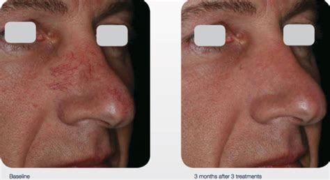 Delray Dermatology Laser Services Nose Delray Dermatology Cosmetic
