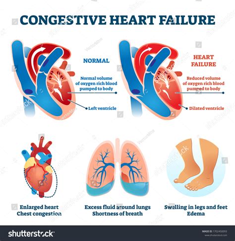 Congestive Heart Failure Vector Illustration Labeled Stock Vector