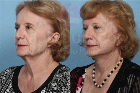 Patient 133182365 Neck Lift Before And After Photos Top Aesthetics