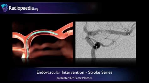 Stroke Endovascular Management Of Ischaemic Stroke Radiology Video Tutorial Youtube