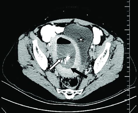 Contrast Enhanced Pelvic Axial Ct Scan Intrauterine Abscess Formation