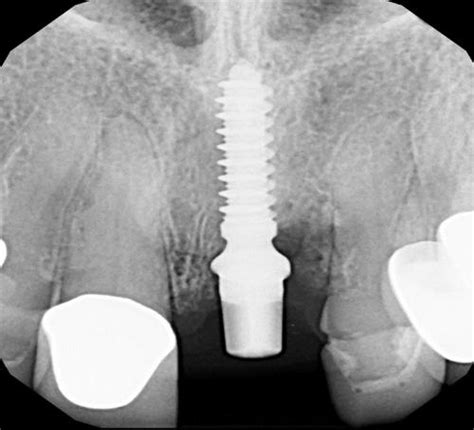 Radiographic Images Just After Implant Placement Download Scientific