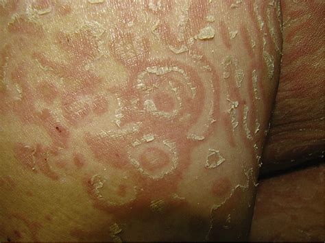 Erythema Gyratum Repens Without Associated Malignancy Journal Of The