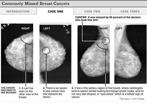 Basic Information About Mammograms