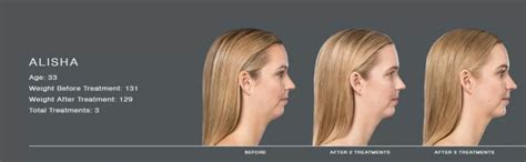 Destroy Excess Fat With Our Kybella Treatment SantÉ Aesthetics And Wellness