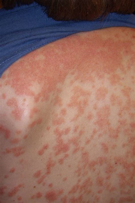 Guttate Psoriasis Causes Symptoms And Treatment