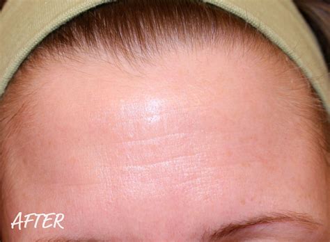 Images For Clogged Pores On Forehead Forehead Clogged Pores Skin Tips