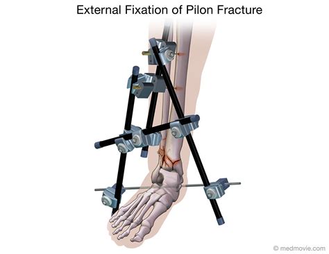 External Fixation Of Pilon Fracture