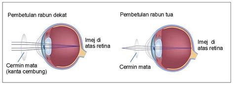 Penyebab rabun dekat adalah lensa mata yang terlalu memipih sehingga tidak dapat memfokuskan bayangan benda secara tepat. RABUN TUA / PRESBYOPIA | UWAIYS OPTOMETRIST