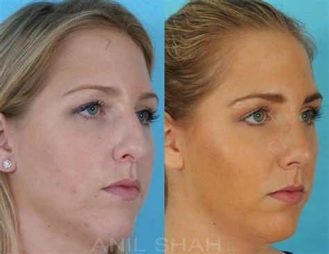 Patient 470 Rhinoplasty Before And After Pictures Rhinoplasty